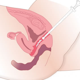 cytotec via vaginal quito